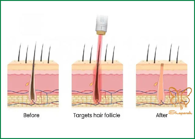 راز لیزر “الکس” فاش شد: آیا همه مراکز لیزر مو زائد به شما حقیقت را میگویند؟
